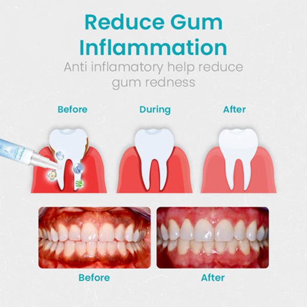 NESLEMY™ Gel Terapia per Gengive – Cura Professionale per la Salute delle Gengive e Prevenzione del Recedimento